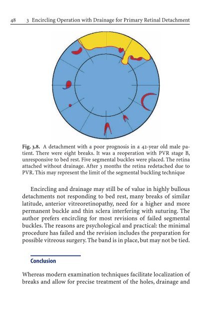 Primary Retinal Detachment