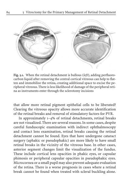 Primary Retinal Detachment