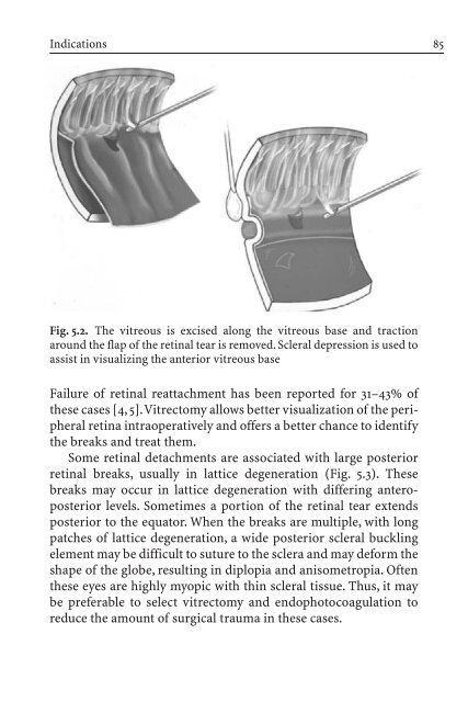 Primary Retinal Detachment