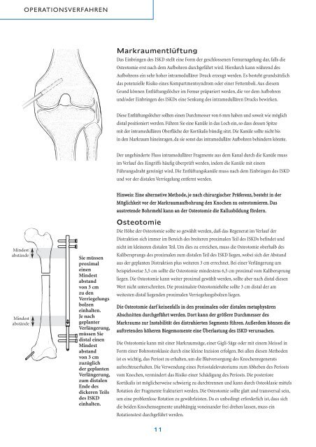 Intramedullärer skelettaler kinetischer Distraktor ISKD - Orthofix.com