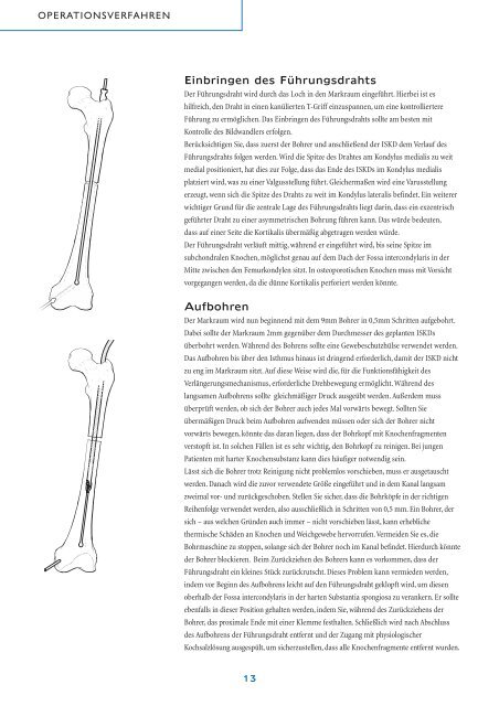 Intramedullärer skelettaler kinetischer Distraktor ISKD - Orthofix.com