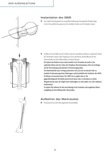 Intramedullärer skelettaler kinetischer Distraktor ISKD - Orthofix.com