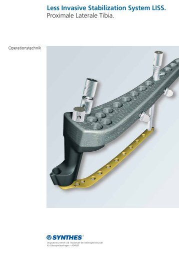 Less Invasive Stabilization System LISS. Proximale ... - Osteosyntese