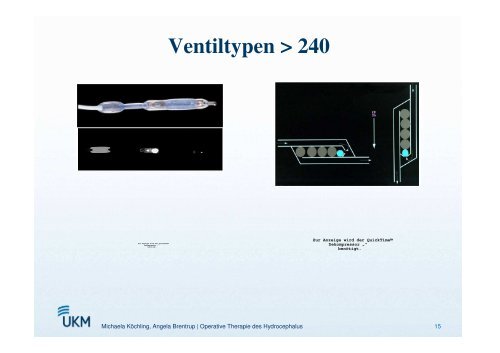 Operative Therapiemöglichkeiten des Hydrozephalus - ASbH