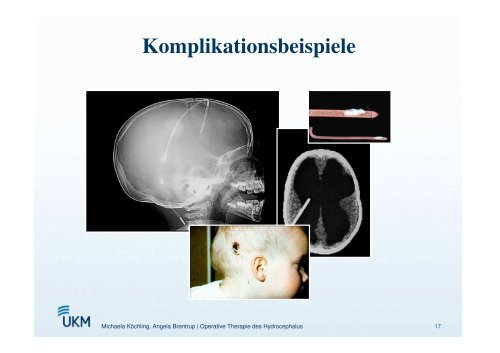 Operative Therapiemöglichkeiten des Hydrozephalus - ASbH