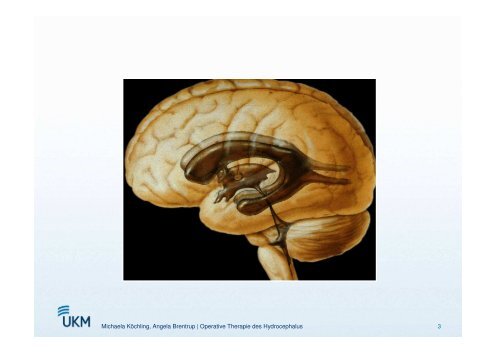 Operative Therapiemöglichkeiten des Hydrozephalus - ASbH