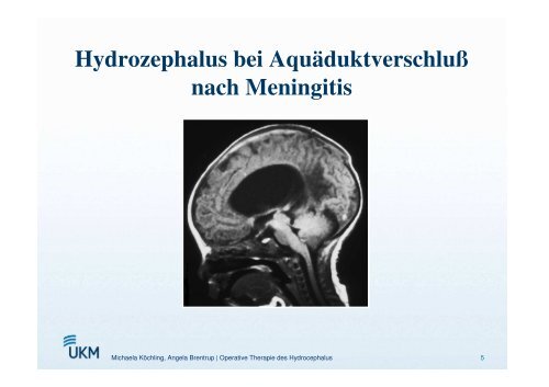 Operative Therapiemöglichkeiten des Hydrozephalus - ASbH