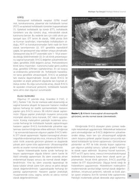 Olgu Sunumu Medial Calcific Sclerosis (Mönckeberg) Case Report