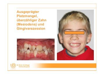 Ausgeprägter Platzmangel, überzähliger Zahn (Mesiodens) und ...