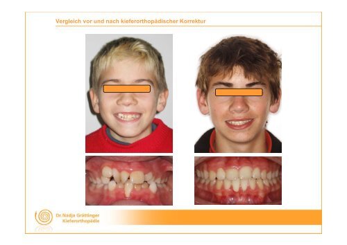 Ausgeprägter Platzmangel, überzähliger Zahn (Mesiodens) und ...