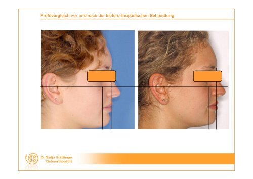 Lingualtechnik in Kombination mit FORSUS-Apparatur