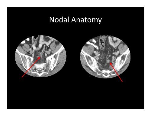 Anal and Rectal Cancers - ASTRO