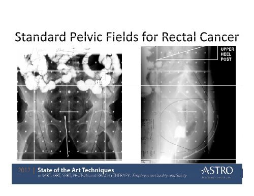 Anal and Rectal Cancers - ASTRO