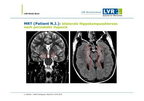 Stellenwert neuropsychologischer Diagnostik für die psychologische ...