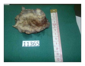 Gastrointestinal Basidiobolomycosis An Unusual Fungal Infection ...