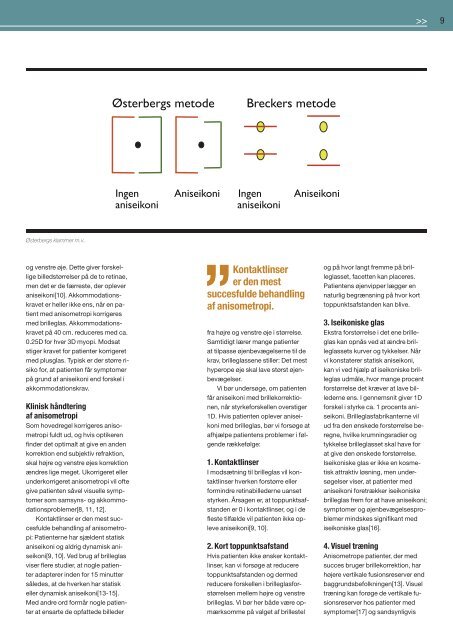 Synsfejl: Astigmatisme og anisometropi